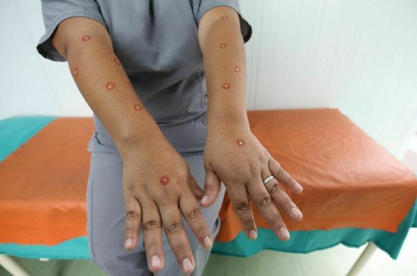 Вирусолог назвала симптомы оспы обезьян